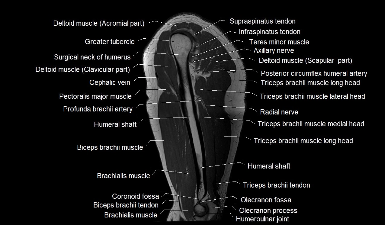 Upper arm (humerus ) saittal cross sectional anatomy 3T image 15.webp